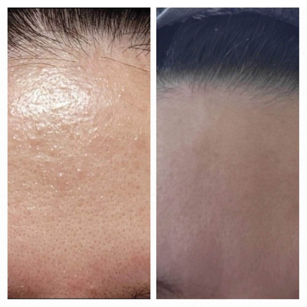 ONE SEED Sparassis Crispa (Cauliflower Mushroom) Pure Serum / 3-Day SOS Calming Solution | Pure Beta-Glucan Recovery