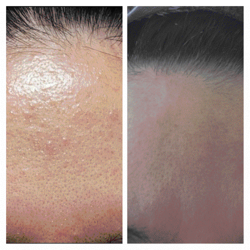 ONE SEED Sparassis Crispa (Cauliflower Mushroom) Pure Serum / 3-Day SOS Calming Solution | Pure Beta-Glucan Recovery